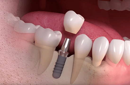 Implantologia ad Alba - Studio Dentistico Dott. Borelli